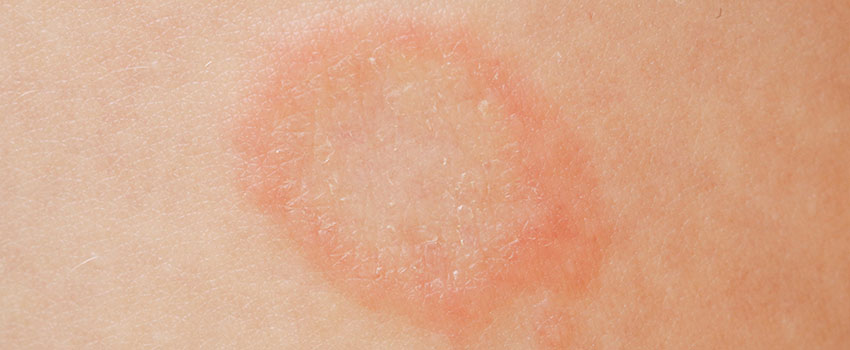 Is Ringworm Serious?