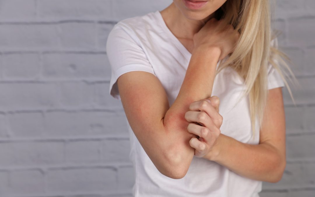Do I Have Eczema or Psoriasis?
