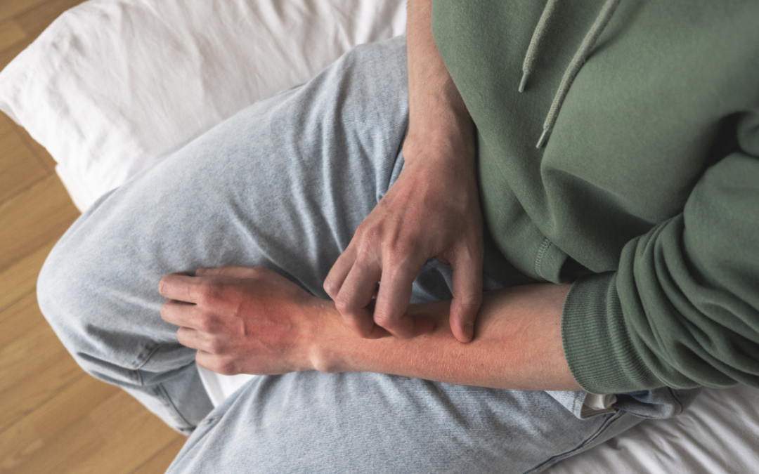 Top Signs You Might Have Heat Rash