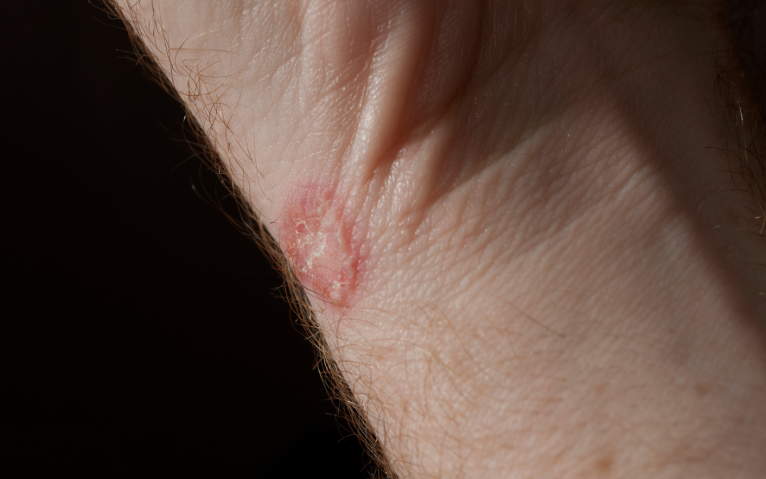 What You Need to Know About Ringworm