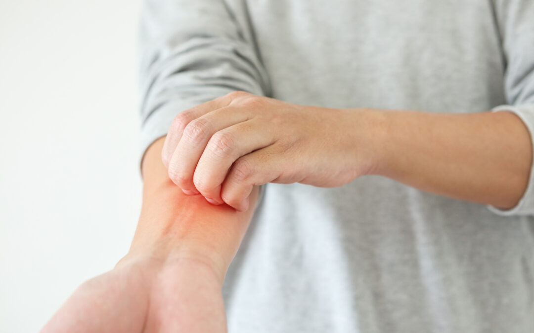 Young man itching and scratching on arm from itchy dry skin